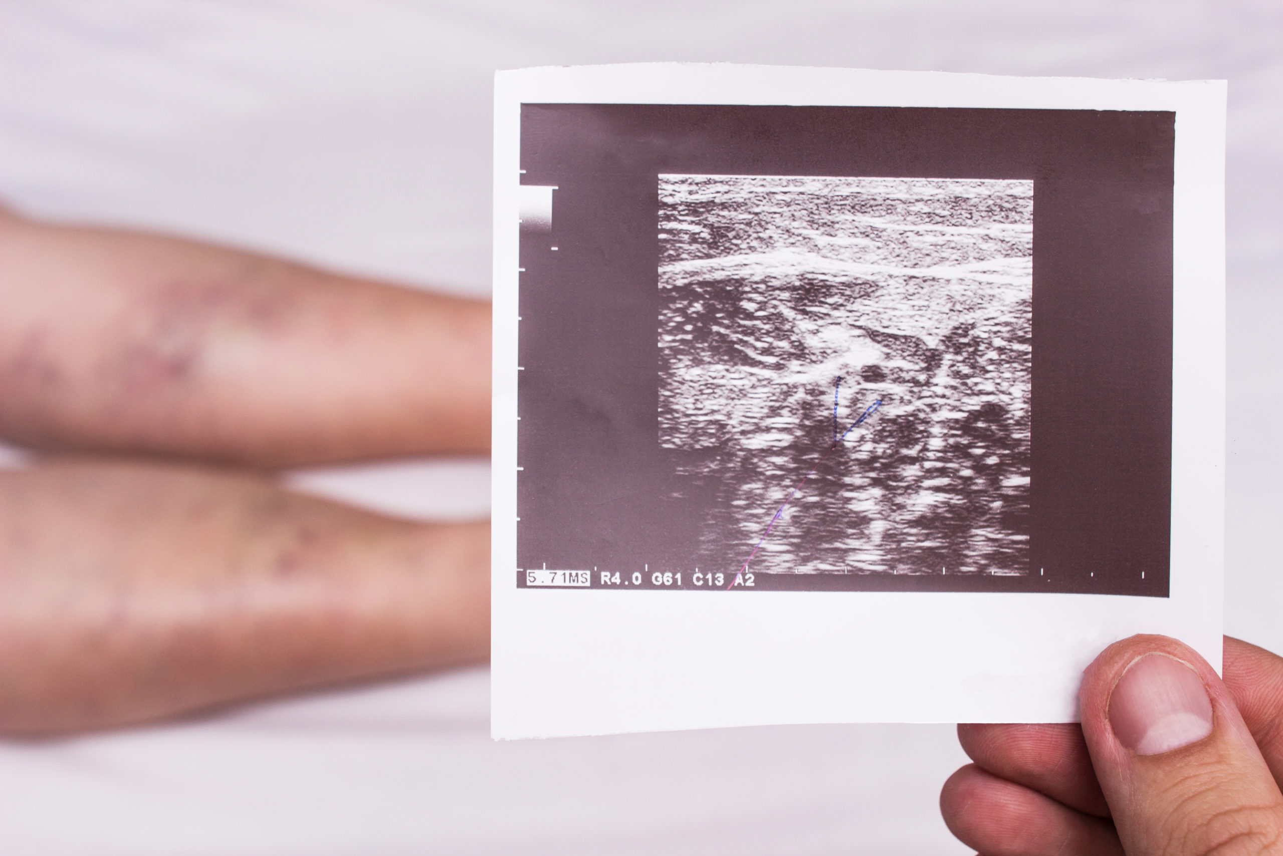 Thrombophlebitis detected on ultrasound