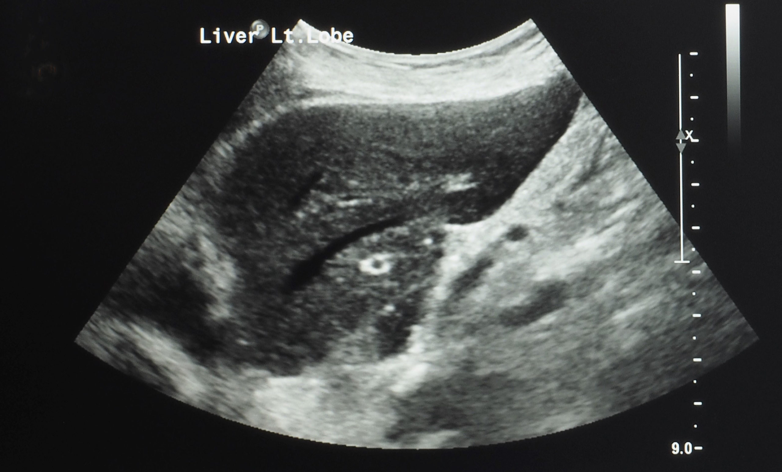 Liver and kidney ultrasound image