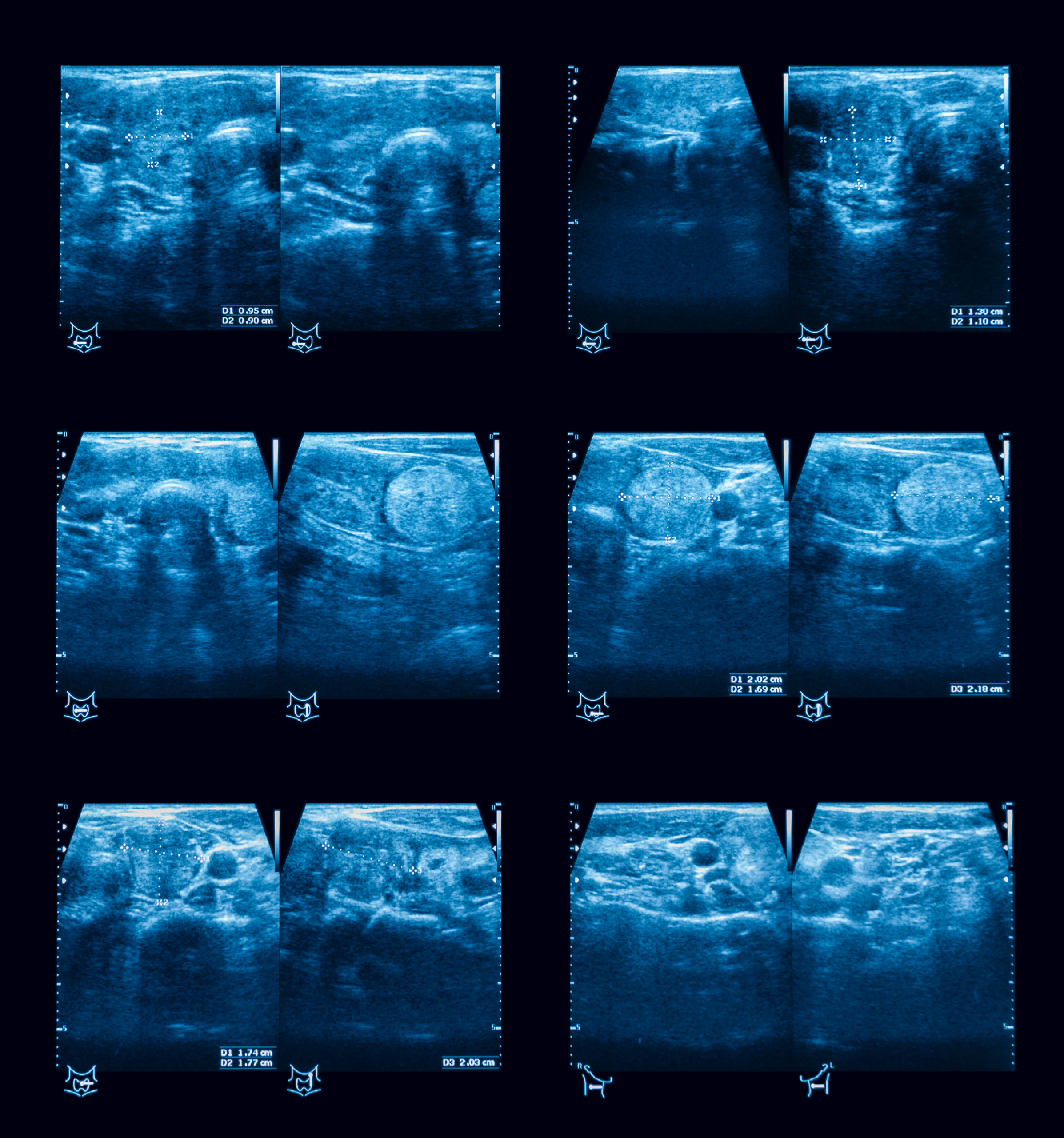 Ultrasound image of a thyroid nodule